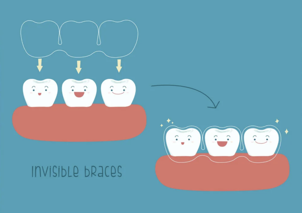 invisalign for kids Beverly Hills