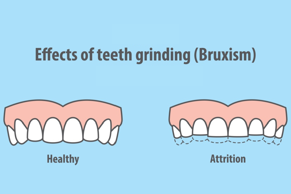 teeth grinding bruxism