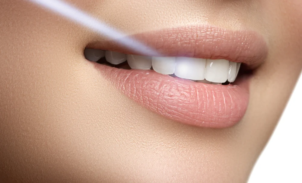 professional teeth whitening in beverly hills ca