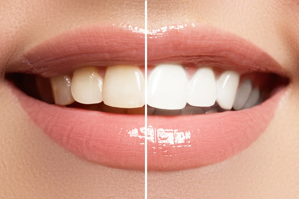 professional teeth whitening in beverly hills ca