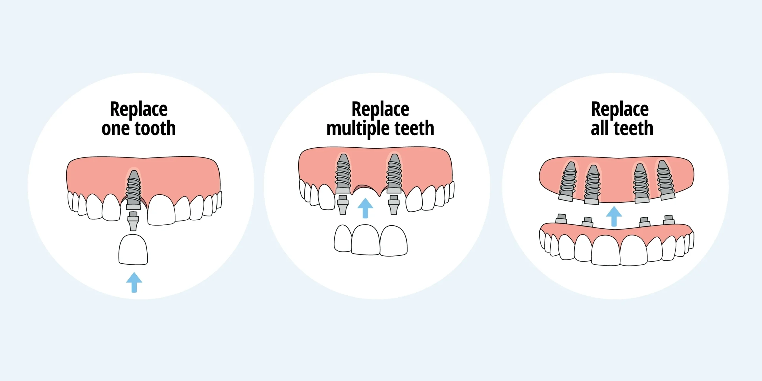 dental implants beverly hills ca