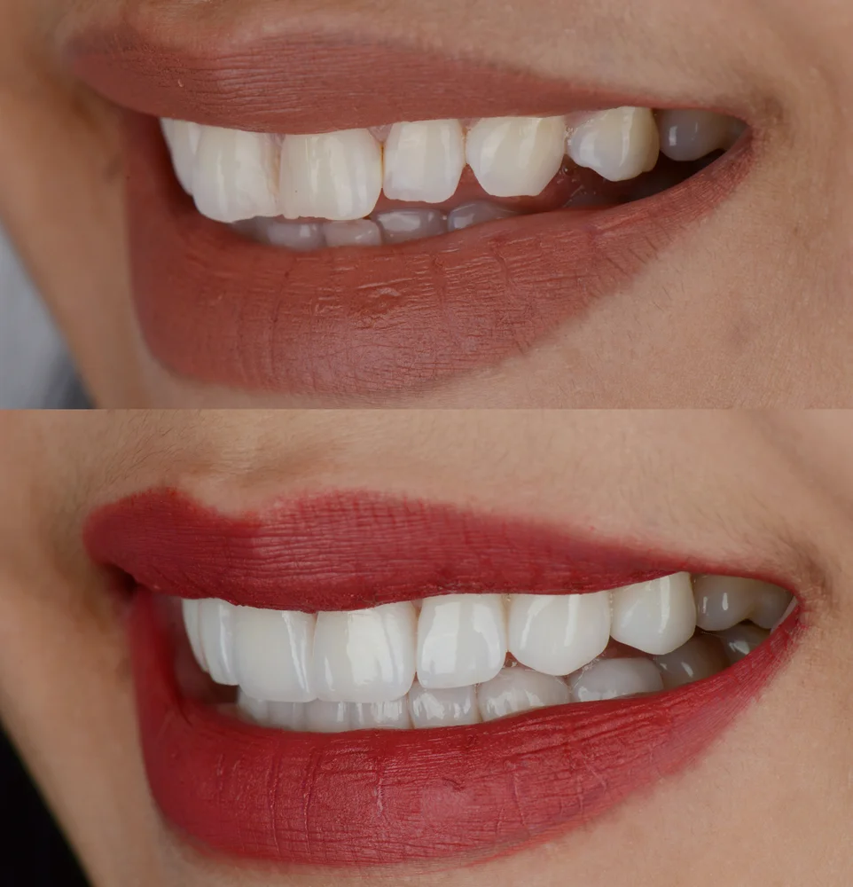teeth whitening beverly hills ca