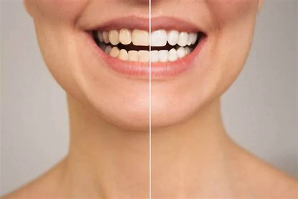 Metal Crowns: The Durable Choice for Molar Health