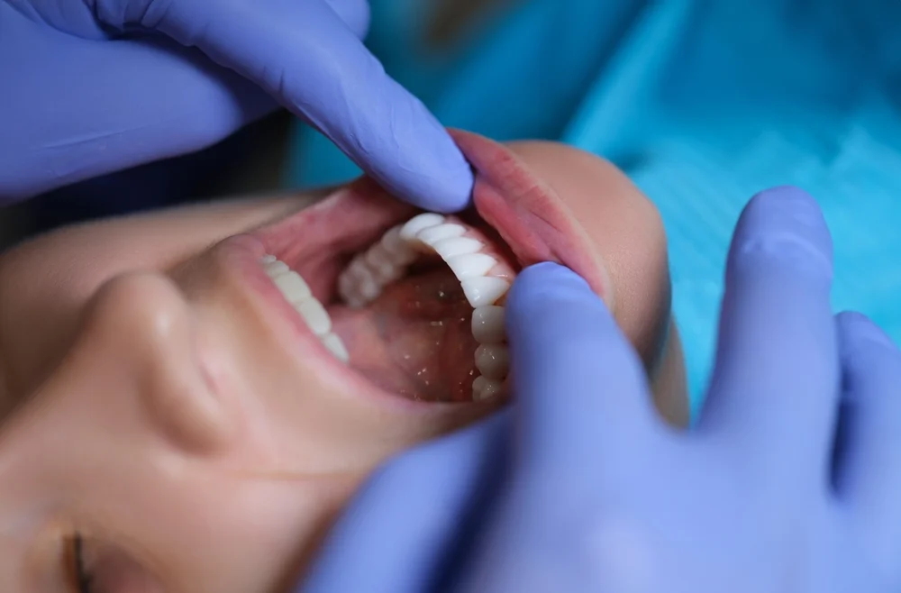 Comparing Porcelain and Composite Veneers in Beverly Hills