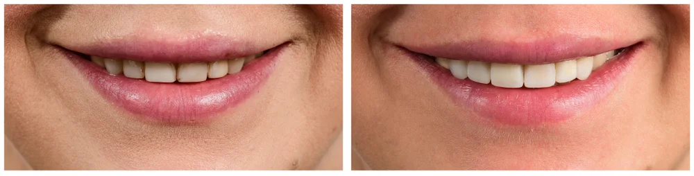 Composite Veneer Replacement: What You Need to Know
