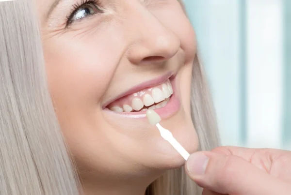 Veneer Replacement: When and Why You Should Consider It