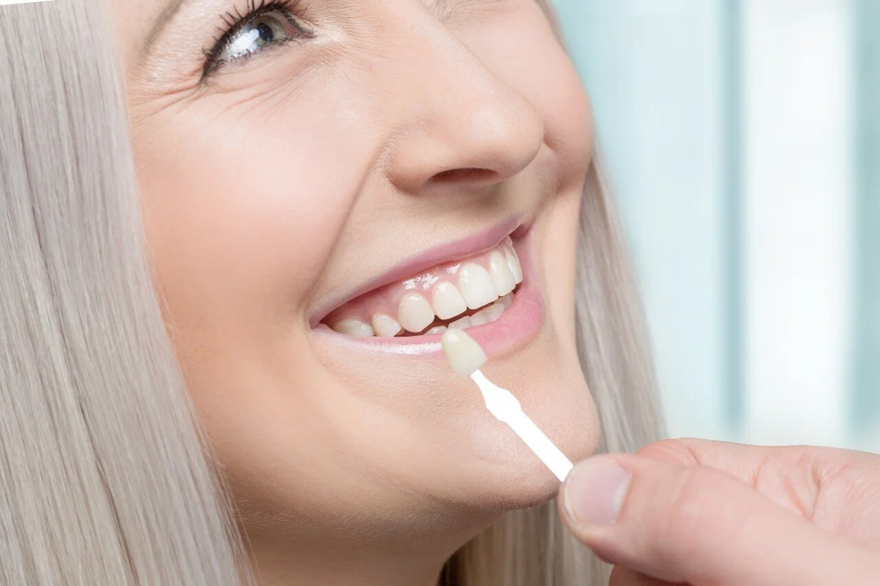 Veneer Replacement: When and Why You Should Consider It