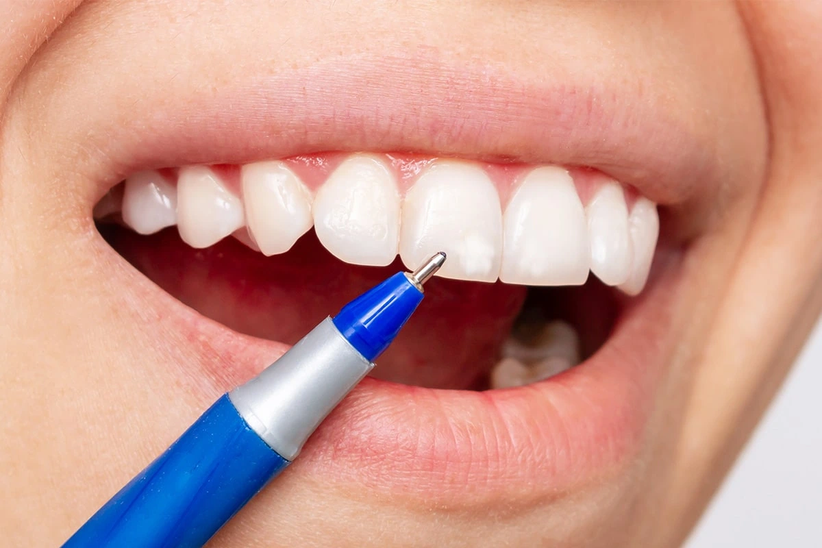 Gold Crowns: The Durable Crown Dental Choice for Back Teeth