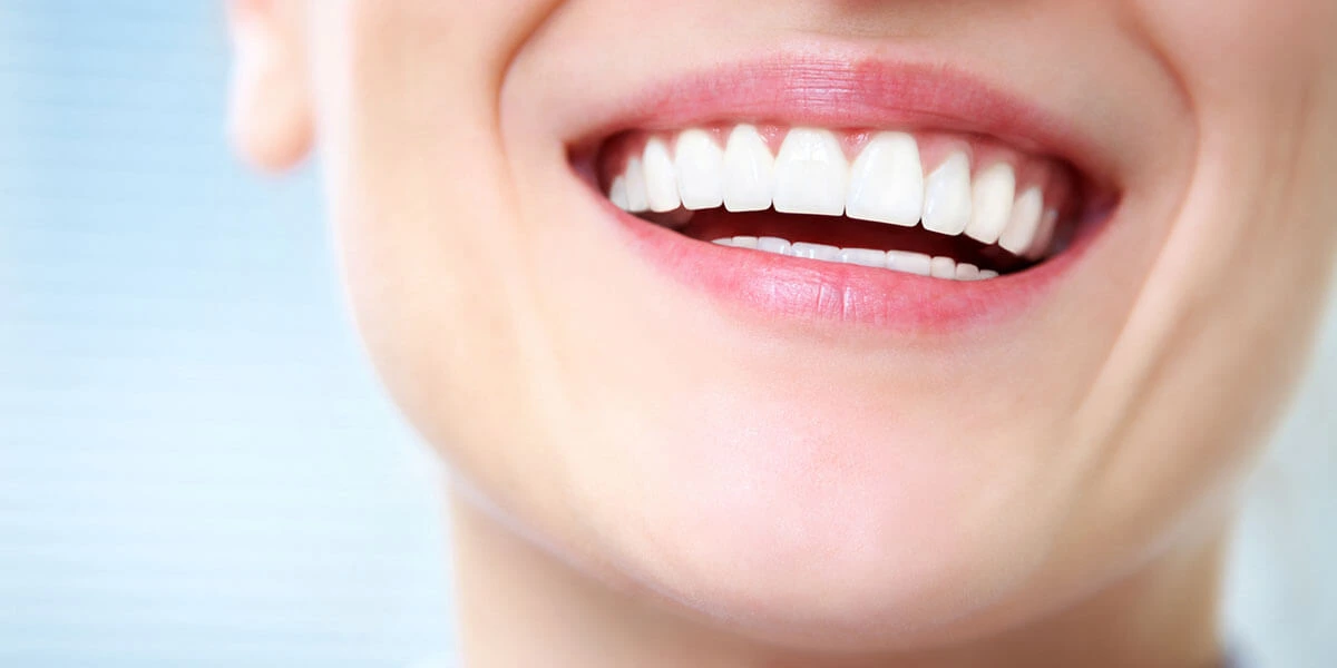 Hollywood Smile: Achieving Stunning Results with Veneers
