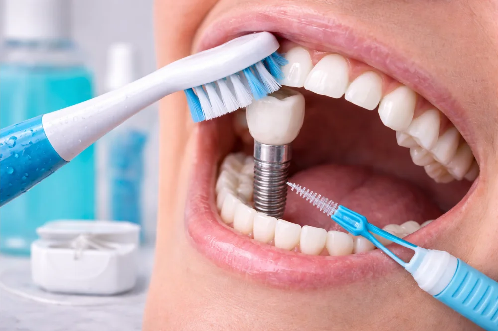 The Key to Long-Lasting Dental Implants: Maintenance Tips