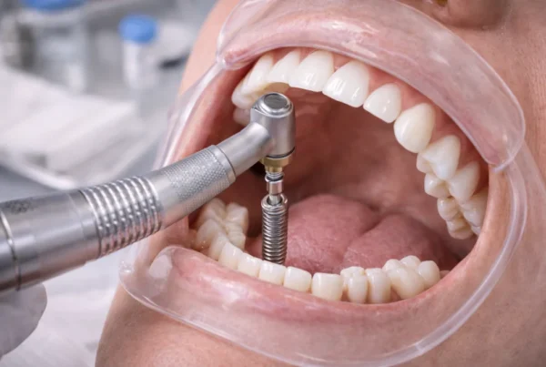 Step-by-Step Guide to the Dental Implant Procedure